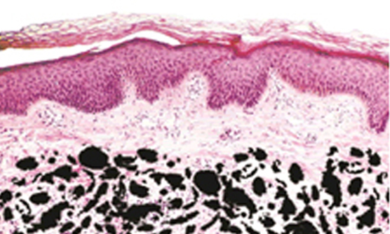 皮膚内のタトゥーの色素のイメージ