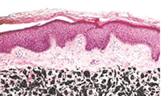 Qスイッチレーザー照射後のイメージ